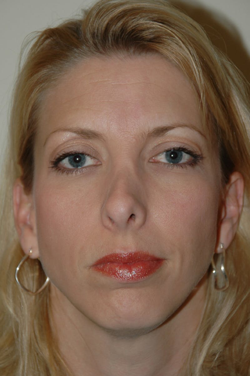 Revision Rhinoplasty Before & After Gallery - Patient 54673300 - Image 3