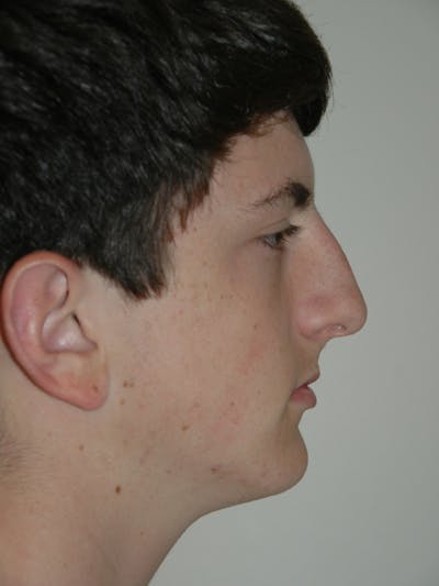 Rhinoplasty Before & After Gallery - Patient 53824147 - Image 1