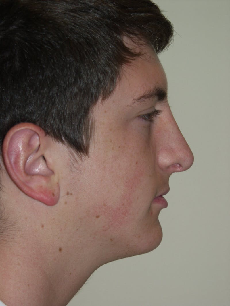 Rhinoplasty Before & After Gallery - Patient 53824147 - Image 2