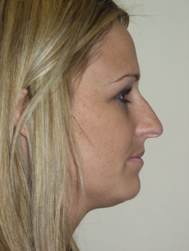 Rhinoplasty Before & After Gallery - Patient 53824148 - Image 1