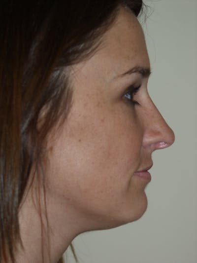 Rhinoplasty Before & After Gallery - Patient 53824148 - Image 2