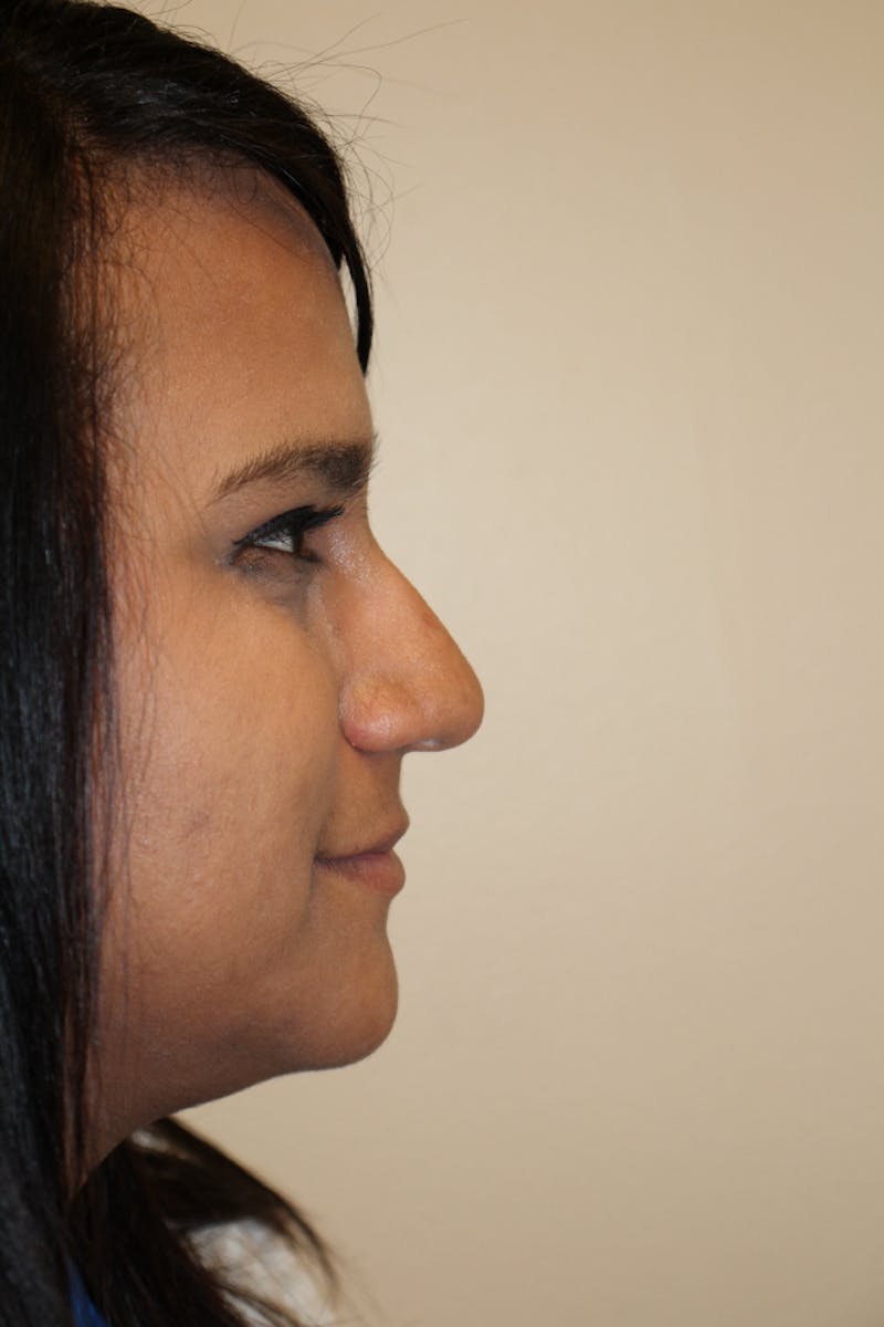 Rhinoplasty Before & After Gallery - Patient 53824210 - Image 1
