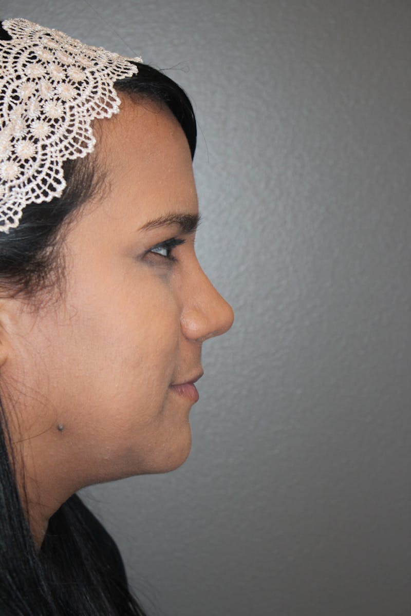 Rhinoplasty Before & After Gallery - Patient 53824210 - Image 2