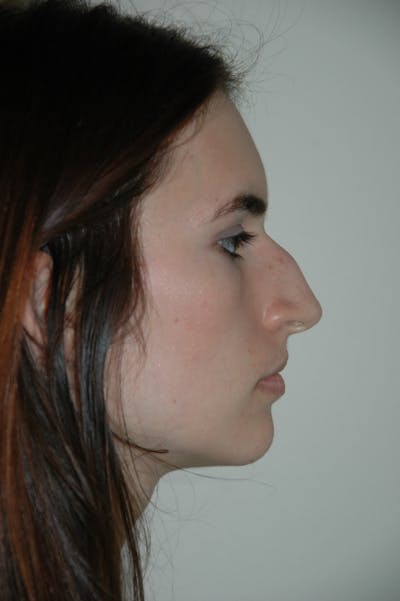 Rhinoplasty Before & After Gallery - Patient 53824324 - Image 1