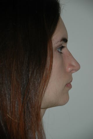 Rhinoplasty Before & After Gallery - Patient 53824324 - Image 2