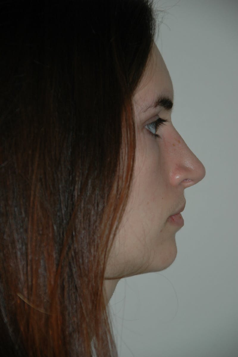 Rhinoplasty Before & After Gallery - Patient 53824324 - Image 2