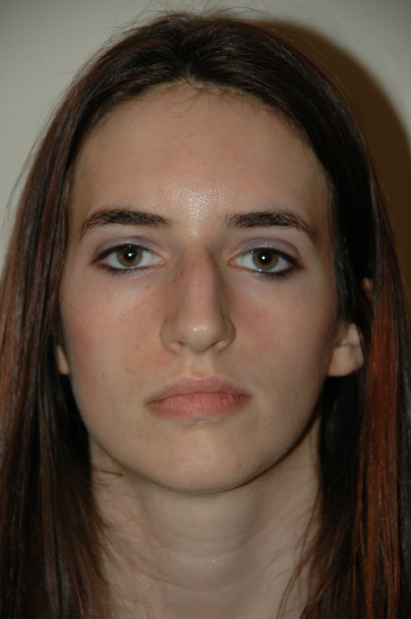 Rhinoplasty Before & After Gallery - Patient 53824324 - Image 3