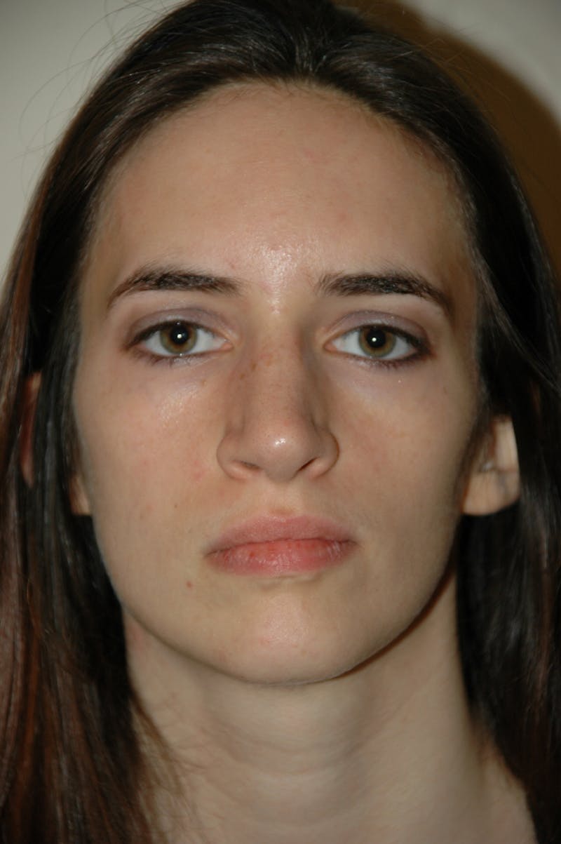 Rhinoplasty Before & After Gallery - Patient 53824324 - Image 4