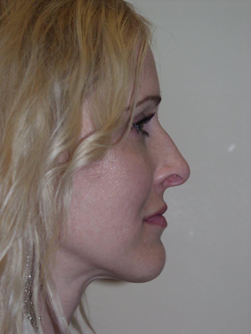 Rhinoplasty Before & After Gallery - Patient 53824325 - Image 1