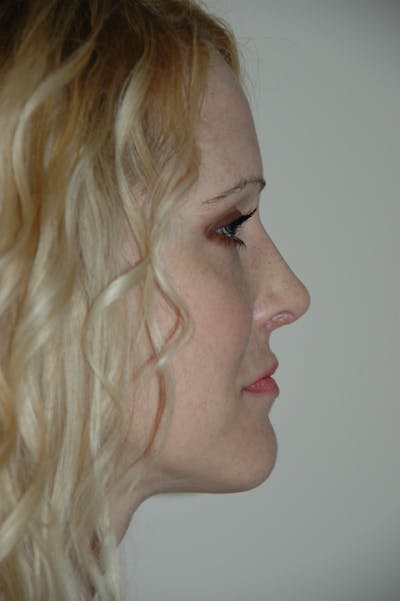Rhinoplasty Before & After Gallery - Patient 53824325 - Image 2