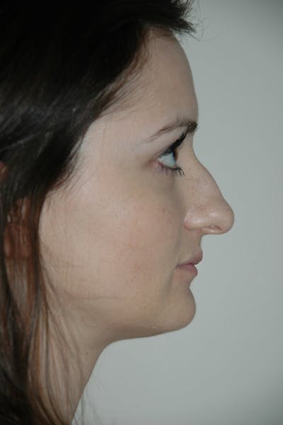 Rhinoplasty Before & After Gallery - Patient 53824457 - Image 1