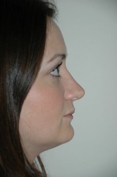 Rhinoplasty Before & After Gallery - Patient 53824457 - Image 2