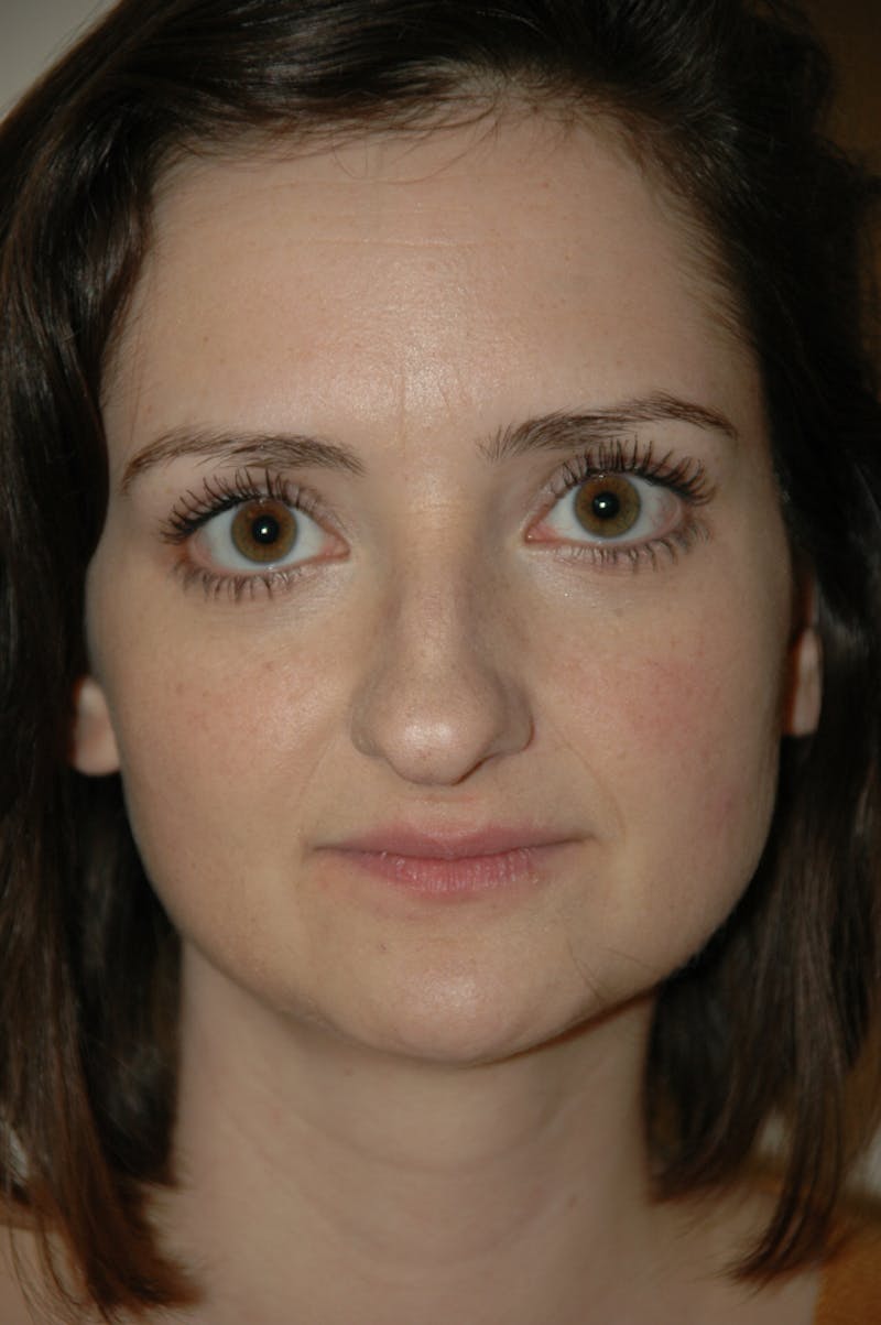Rhinoplasty Before & After Gallery - Patient 53824457 - Image 3