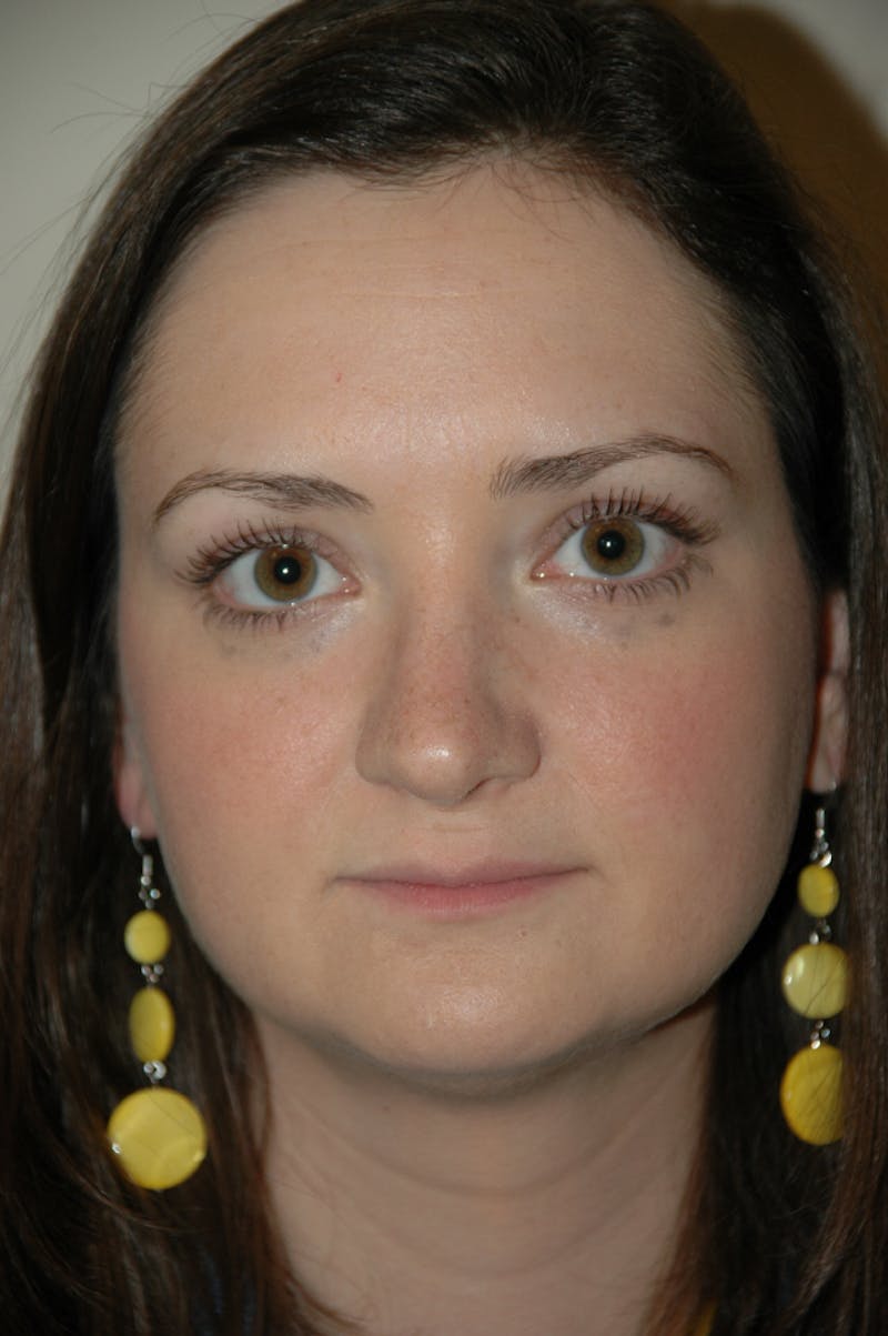 Rhinoplasty Before & After Gallery - Patient 53824457 - Image 4