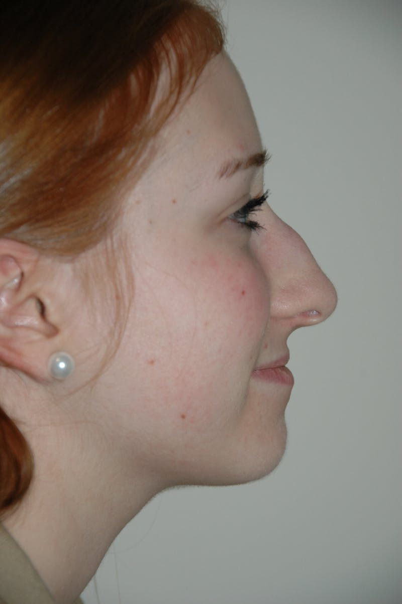 Rhinoplasty Before & After Gallery - Patient 53824458 - Image 1