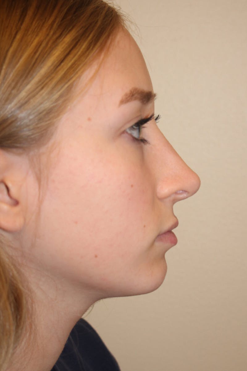 Rhinoplasty Before & After Gallery - Patient 53824458 - Image 2