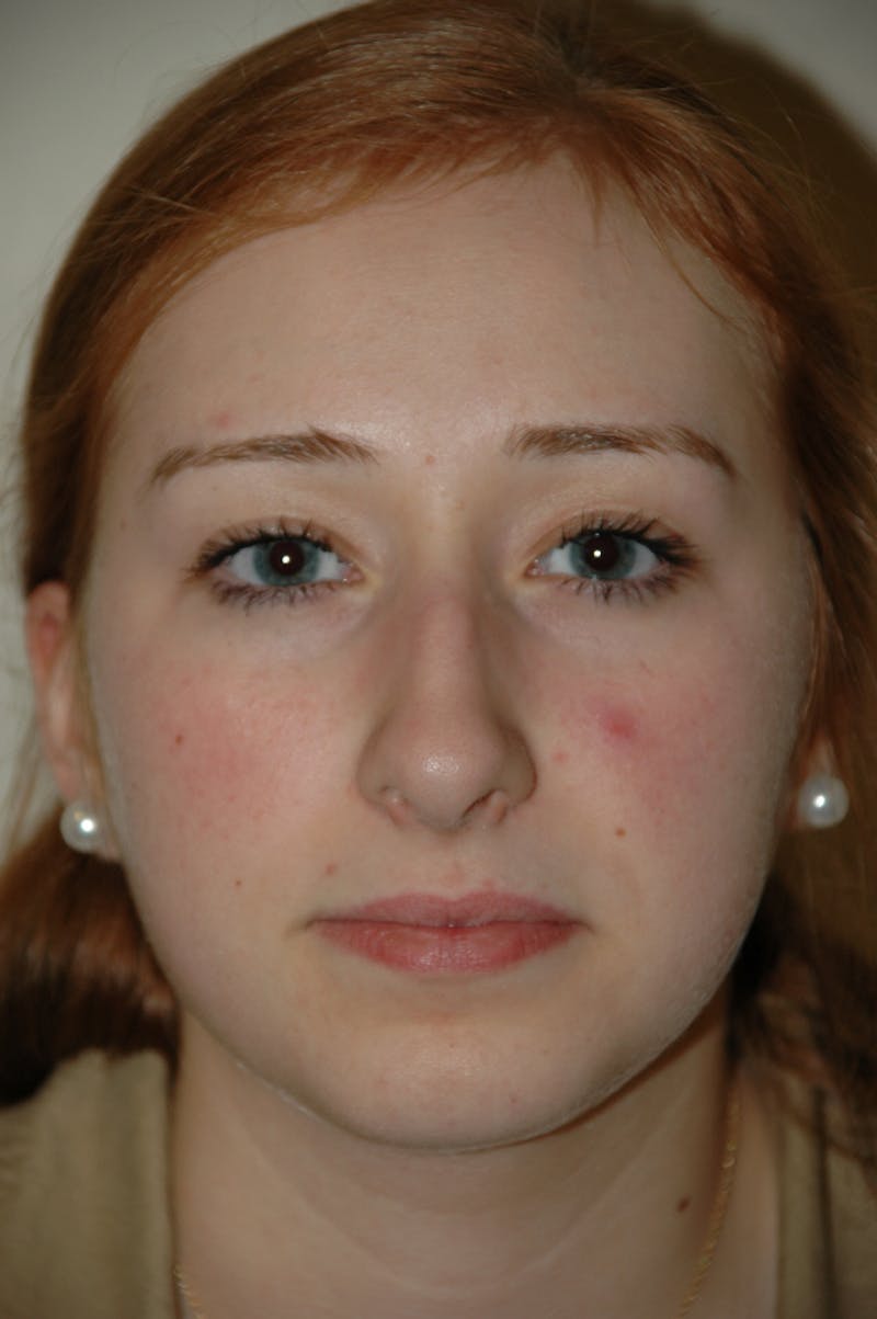 Rhinoplasty Before & After Gallery - Patient 53824458 - Image 3