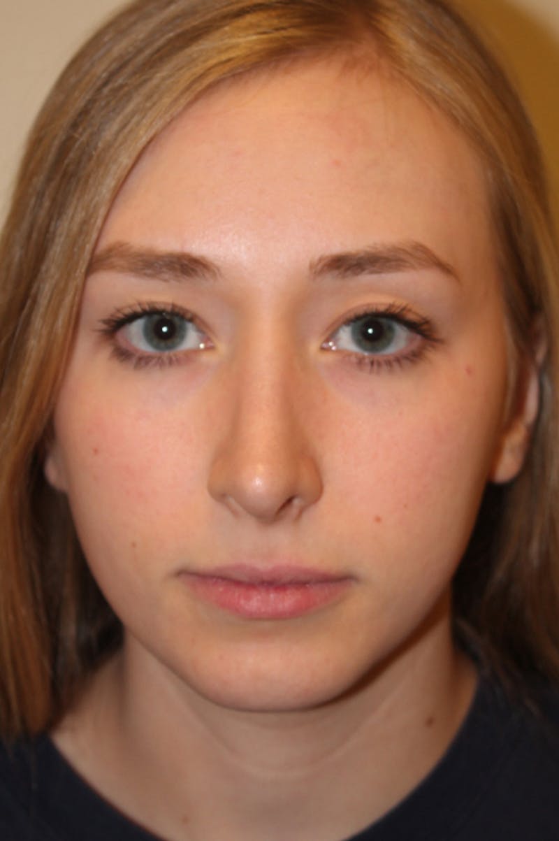 Rhinoplasty Before & After Gallery - Patient 53824458 - Image 4