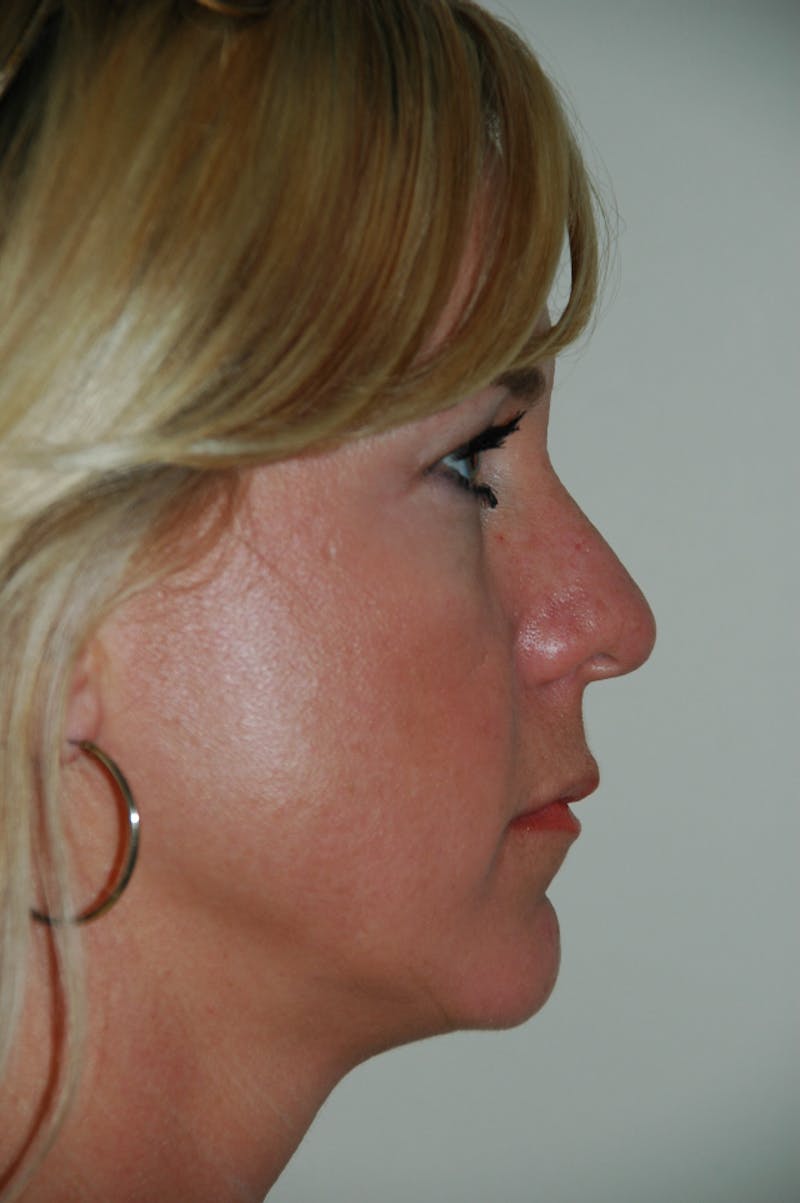 Rhinoplasty Before & After Gallery - Patient 53824531 - Image 1