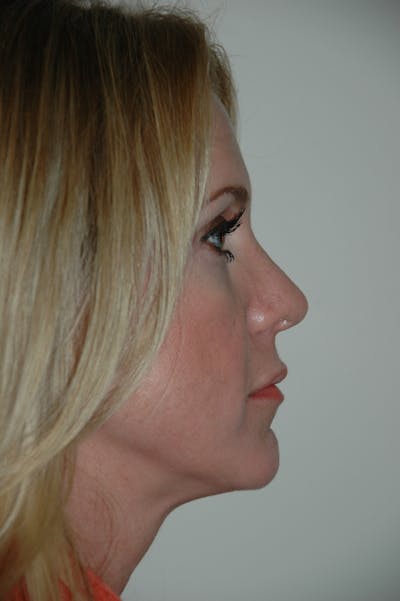 Rhinoplasty Before & After Gallery - Patient 53824531 - Image 2