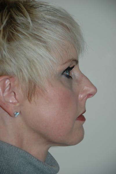 Rhinoplasty Before & After Gallery - Patient 53824585 - Image 1