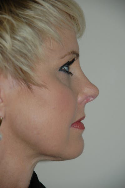 Rhinoplasty Before & After Gallery - Patient 53824585 - Image 2