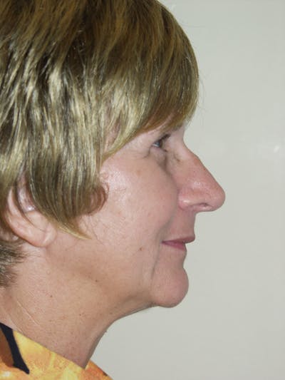 Rhinoplasty Before & After Gallery - Patient 53824586 - Image 1