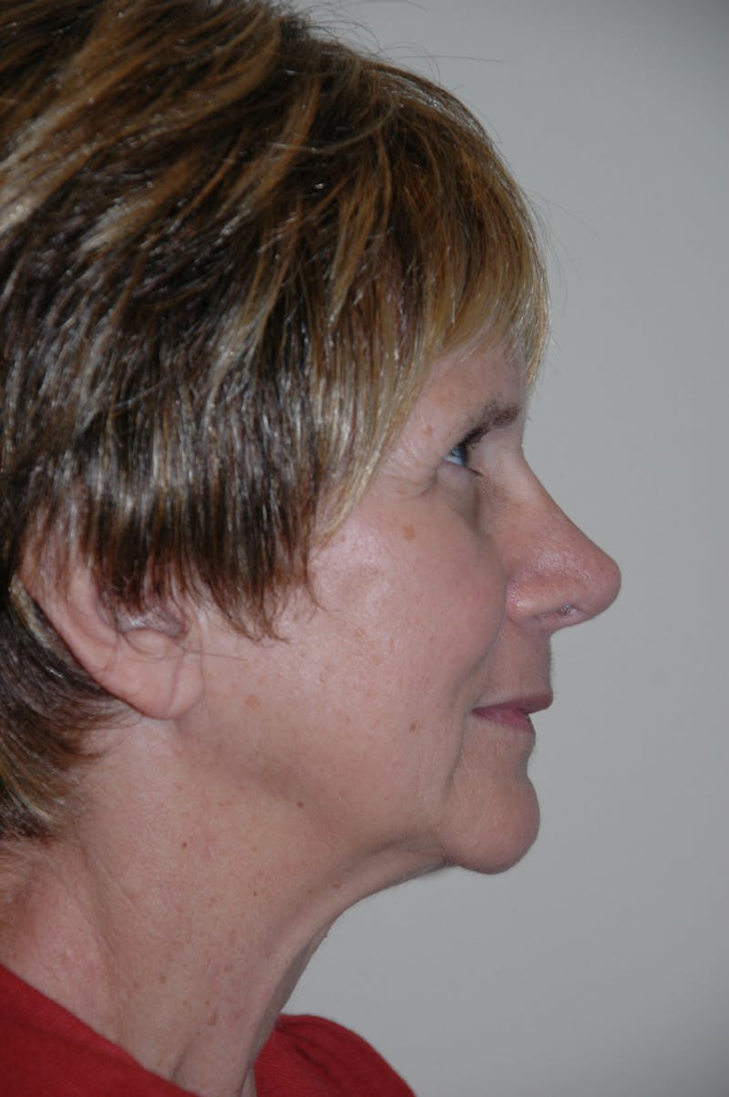 Rhinoplasty Before & After Gallery - Patient 53824586 - Image 2