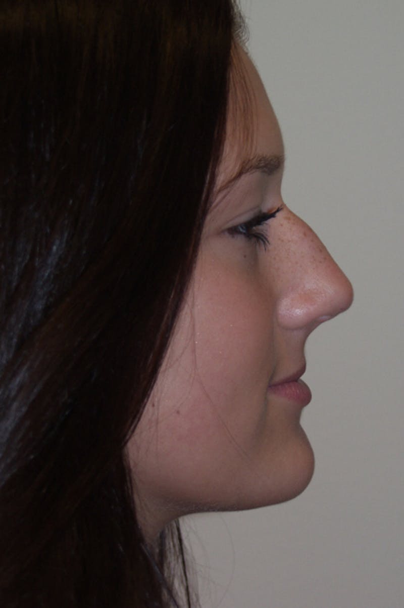 Rhinoplasty Before & After Gallery - Patient 53824782 - Image 1