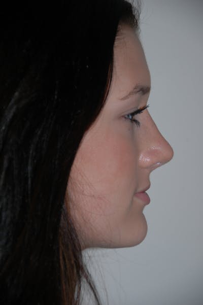 Rhinoplasty Before & After Gallery - Patient 53824782 - Image 2
