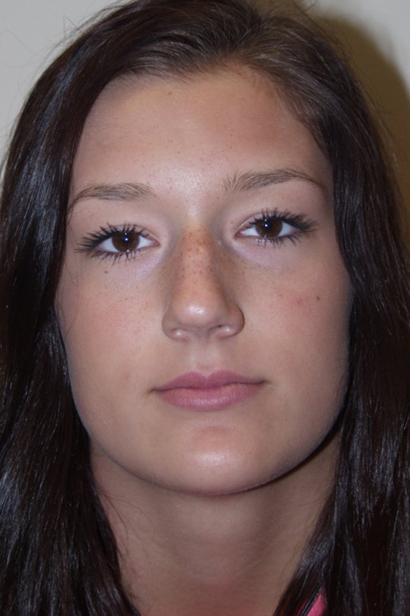 Rhinoplasty Before & After Gallery - Patient 53824782 - Image 3