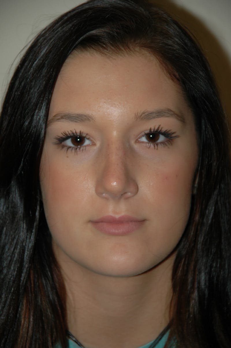 Rhinoplasty Before & After Gallery - Patient 53824782 - Image 4