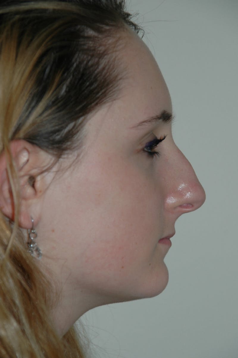 Rhinoplasty Before & After Gallery - Patient 53824882 - Image 1