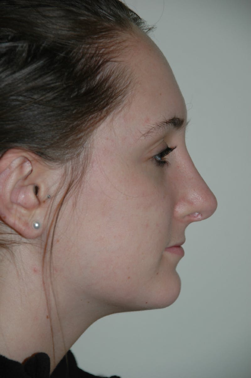 Rhinoplasty Before & After Gallery - Patient 53824882 - Image 2