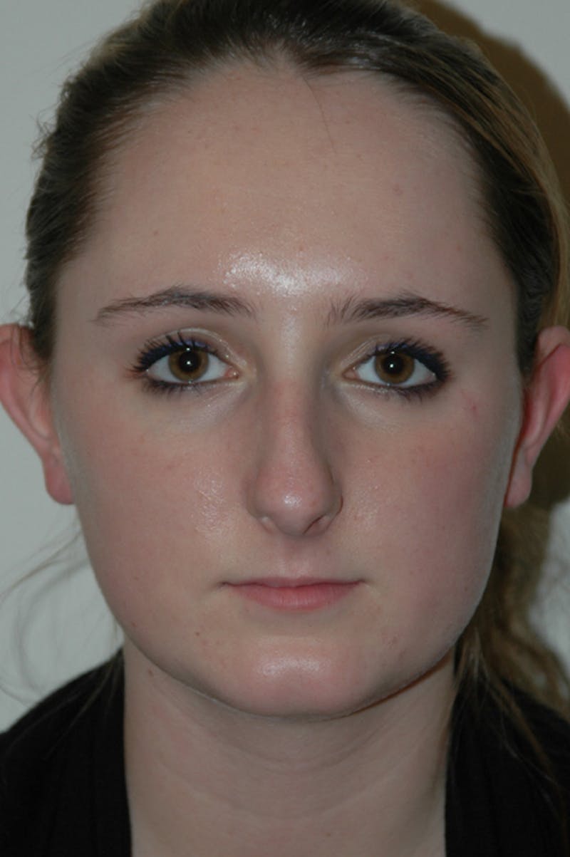 Rhinoplasty Before & After Gallery - Patient 53824882 - Image 3