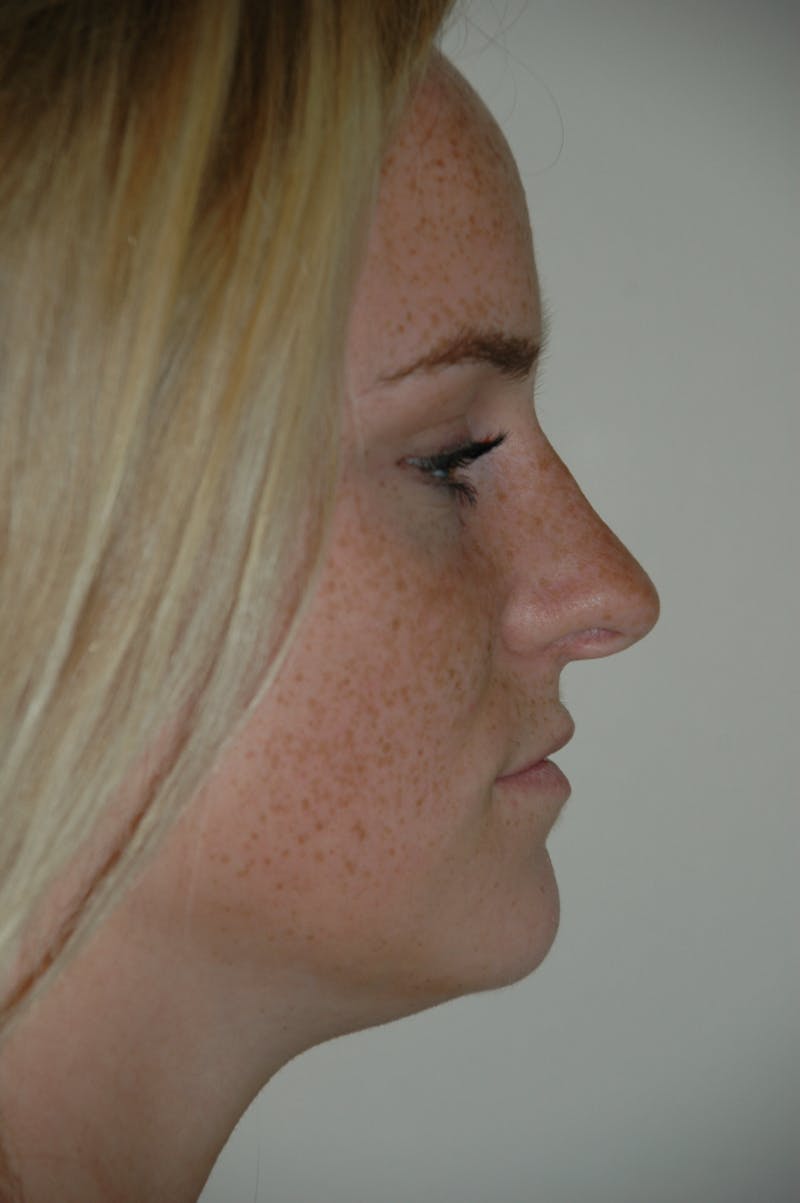 Rhinoplasty Before & After Gallery - Patient 53824970 - Image 1