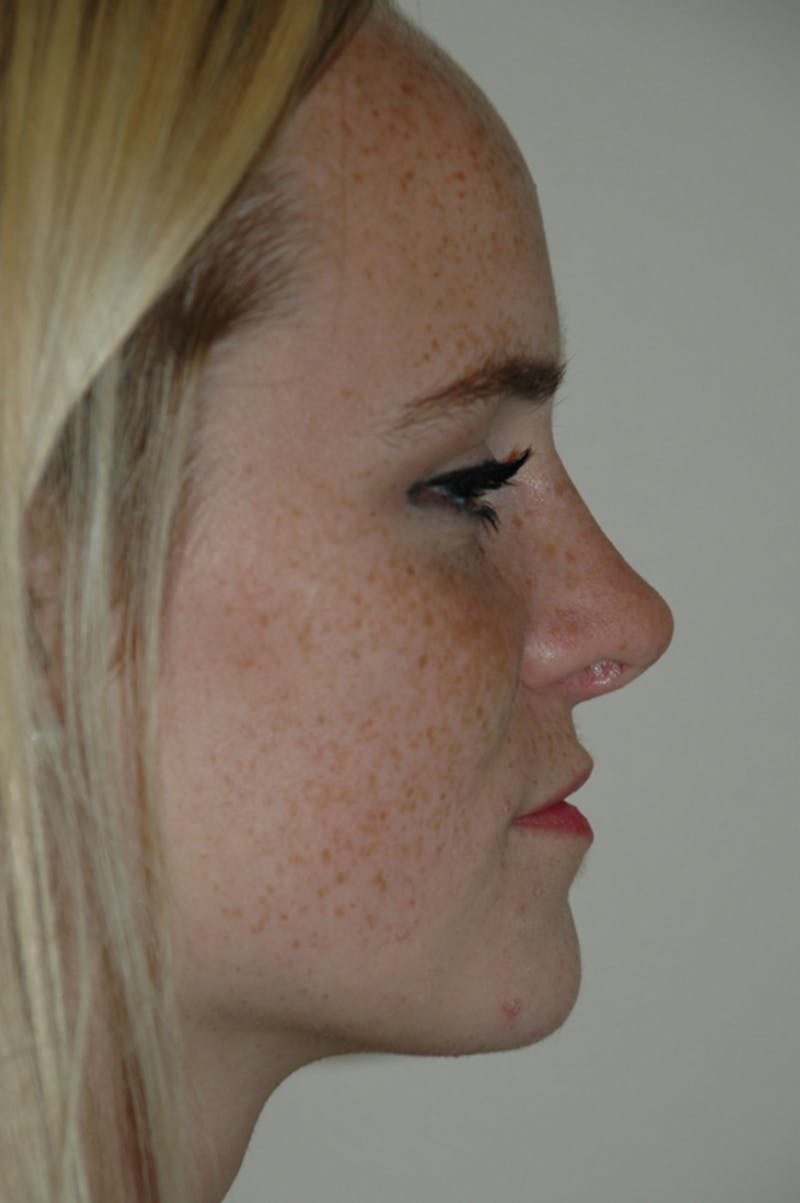 Rhinoplasty Before & After Gallery - Patient 53824970 - Image 2