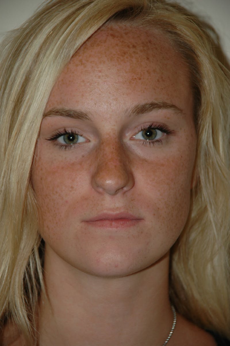 Rhinoplasty Before & After Gallery - Patient 53824970 - Image 3