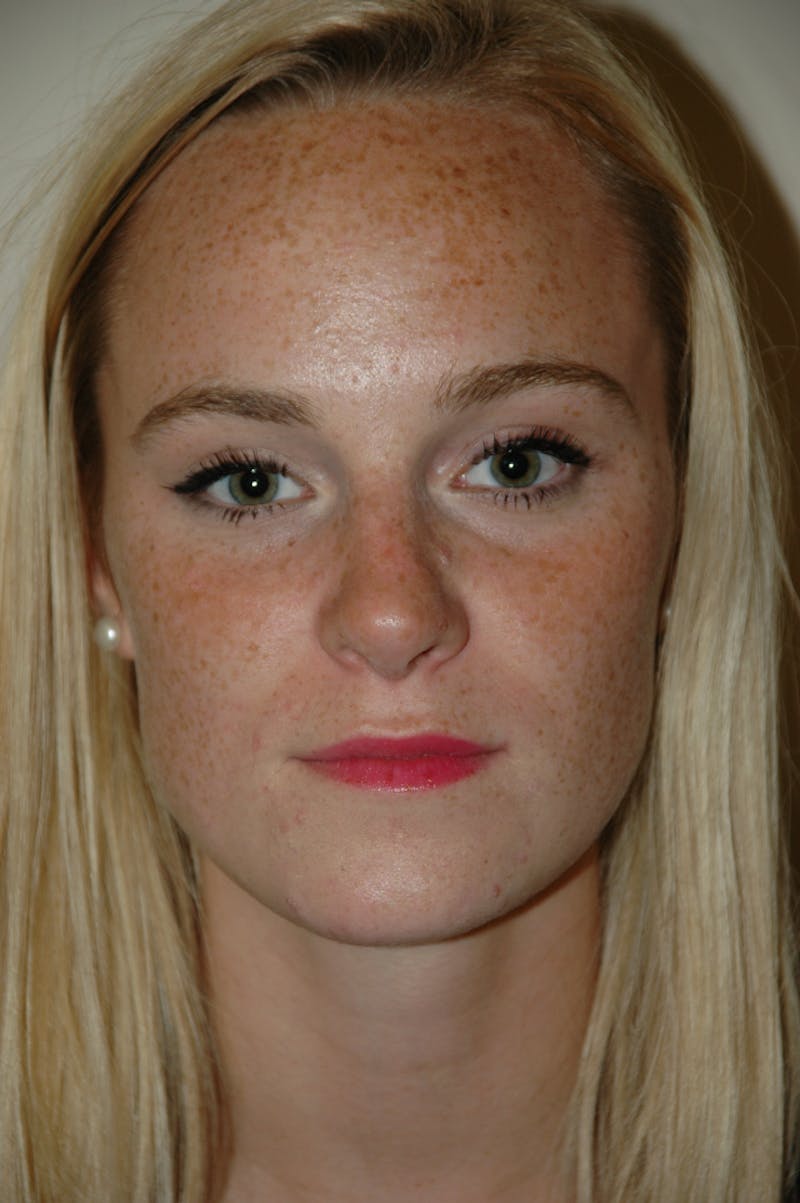 Rhinoplasty Before & After Gallery - Patient 53824970 - Image 4