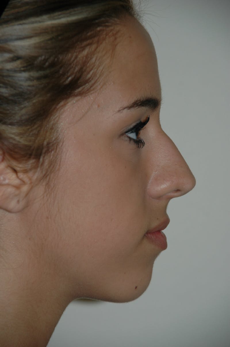 Rhinoplasty Before & After Gallery - Patient 53825279 - Image 1