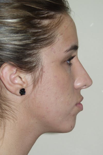 Rhinoplasty Before & After Gallery - Patient 53825279 - Image 2
