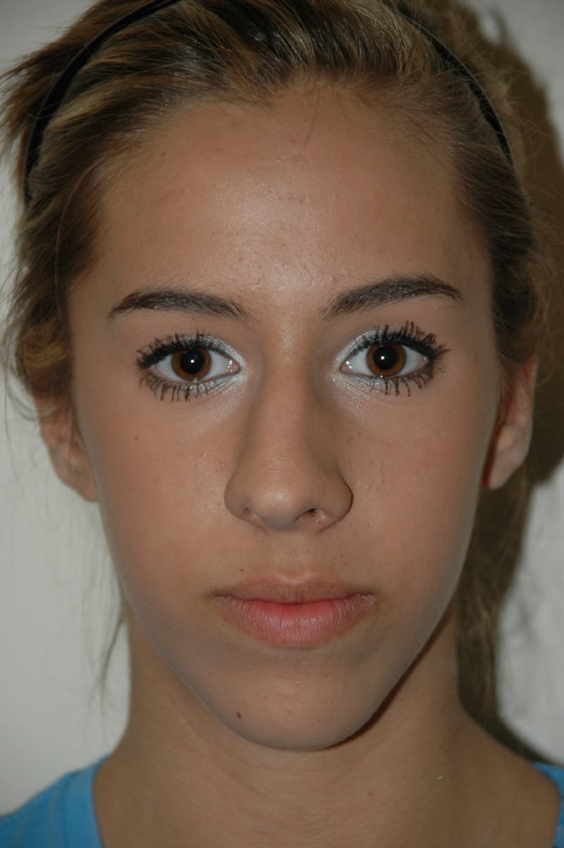 Rhinoplasty Before & After Gallery - Patient 53825279 - Image 3