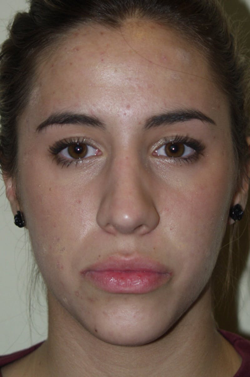 Rhinoplasty Before & After Gallery - Patient 53825279 - Image 4