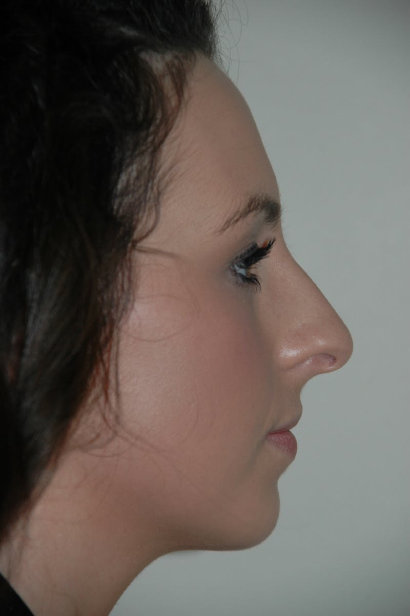 Rhinoplasty Before & After Gallery - Patient 53825280 - Image 1