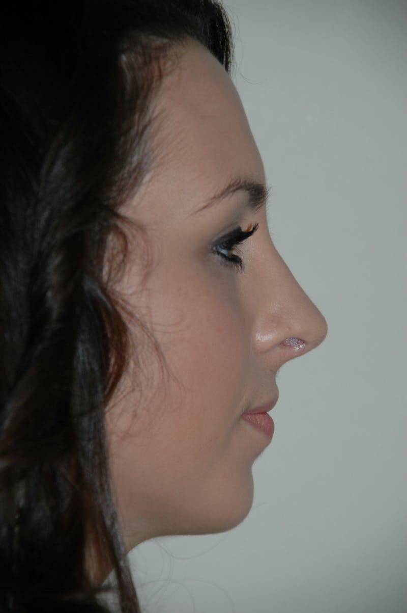 Rhinoplasty Before & After Gallery - Patient 53825280 - Image 2