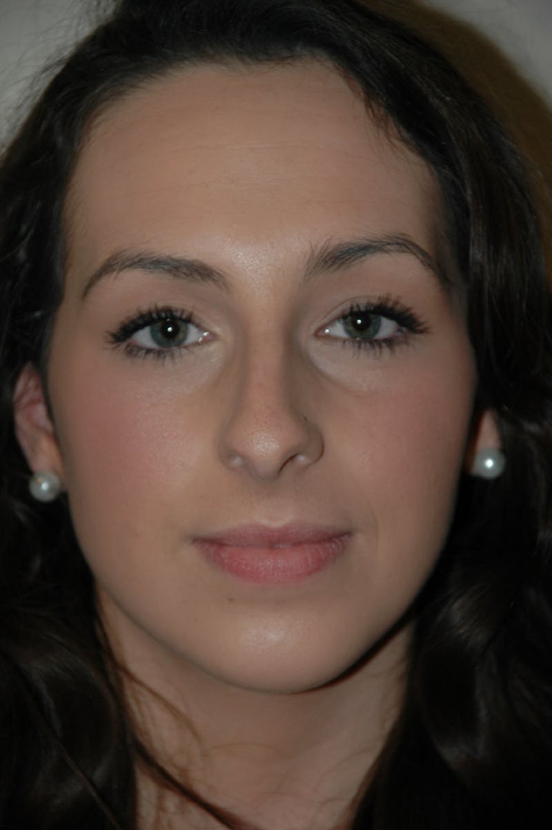 Rhinoplasty Before & After Gallery - Patient 53825280 - Image 4