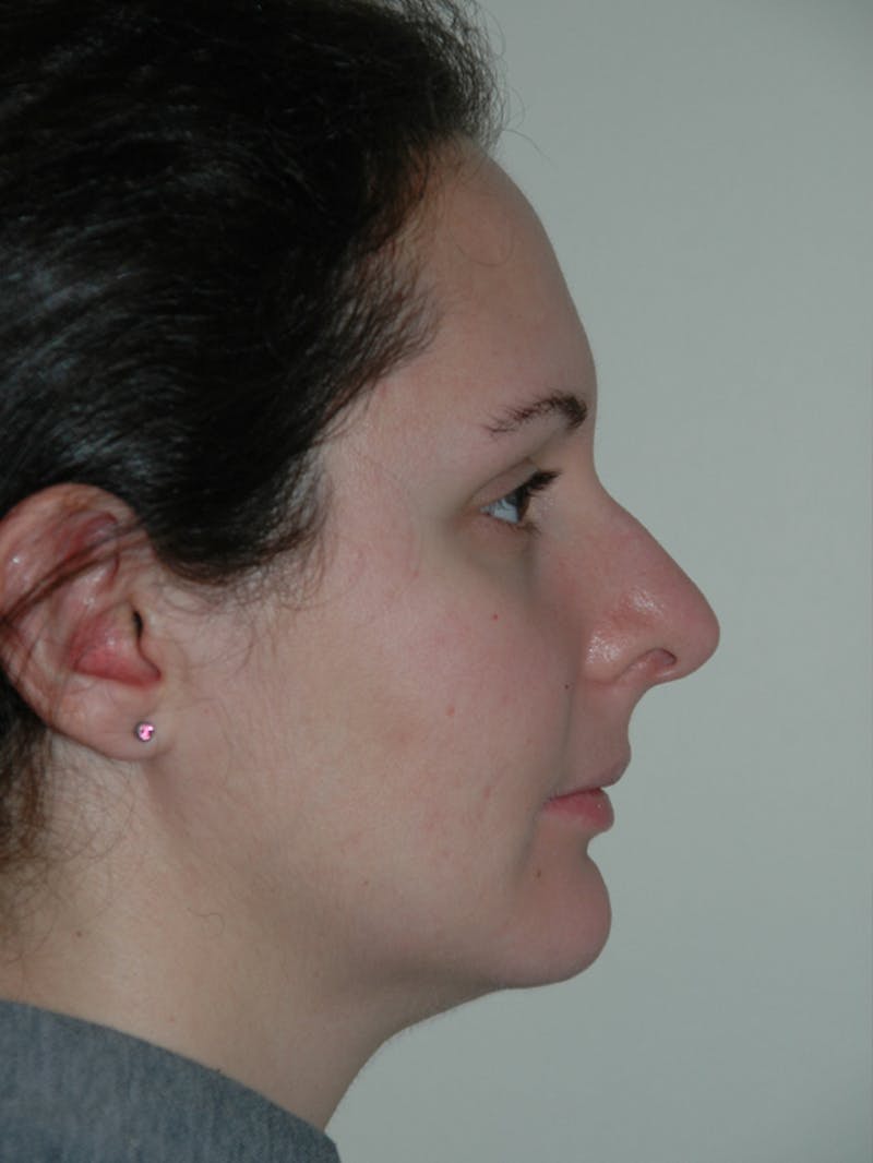 Rhinoplasty Before & After Gallery - Patient 53825281 - Image 1
