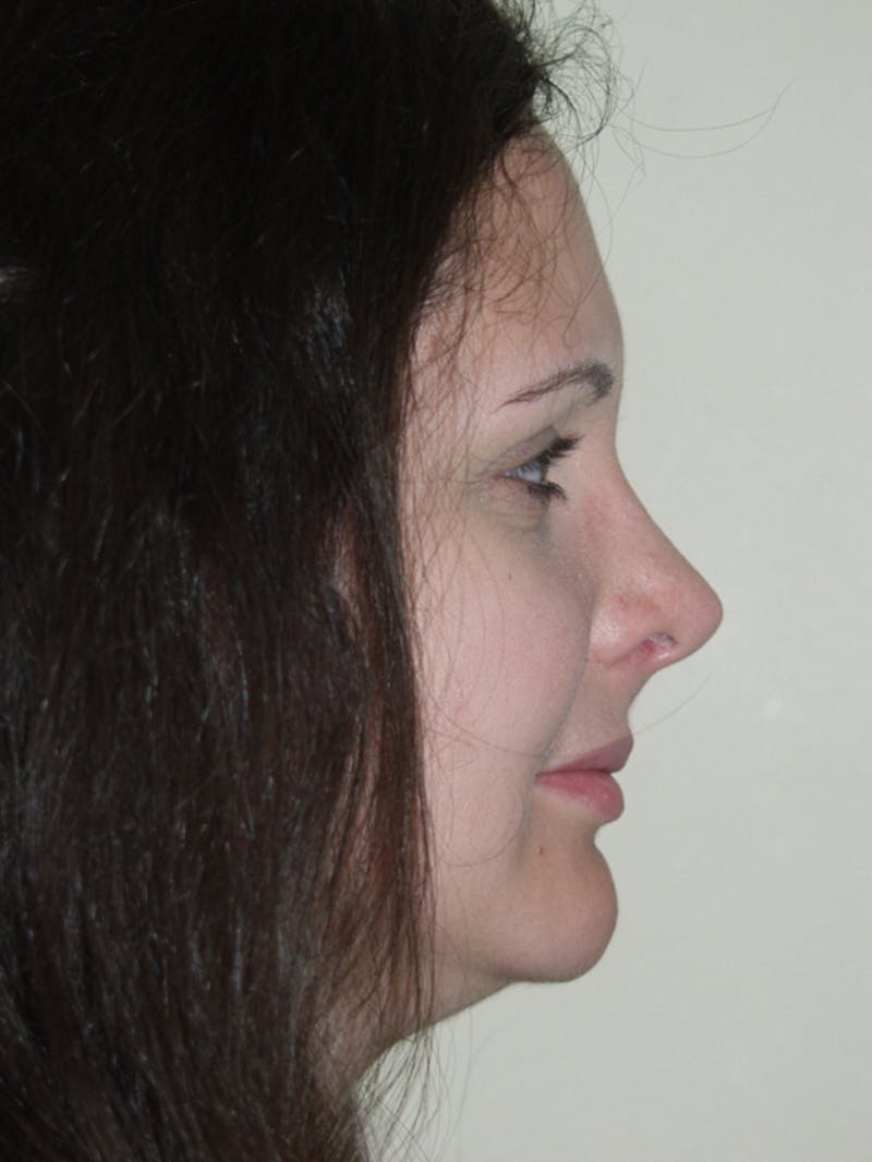 Rhinoplasty Before & After Gallery - Patient 53825281 - Image 2