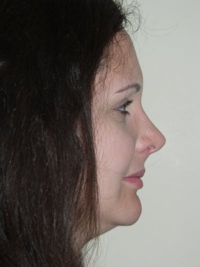 Rhinoplasty Before & After Gallery - Patient 53825281 - Image 2