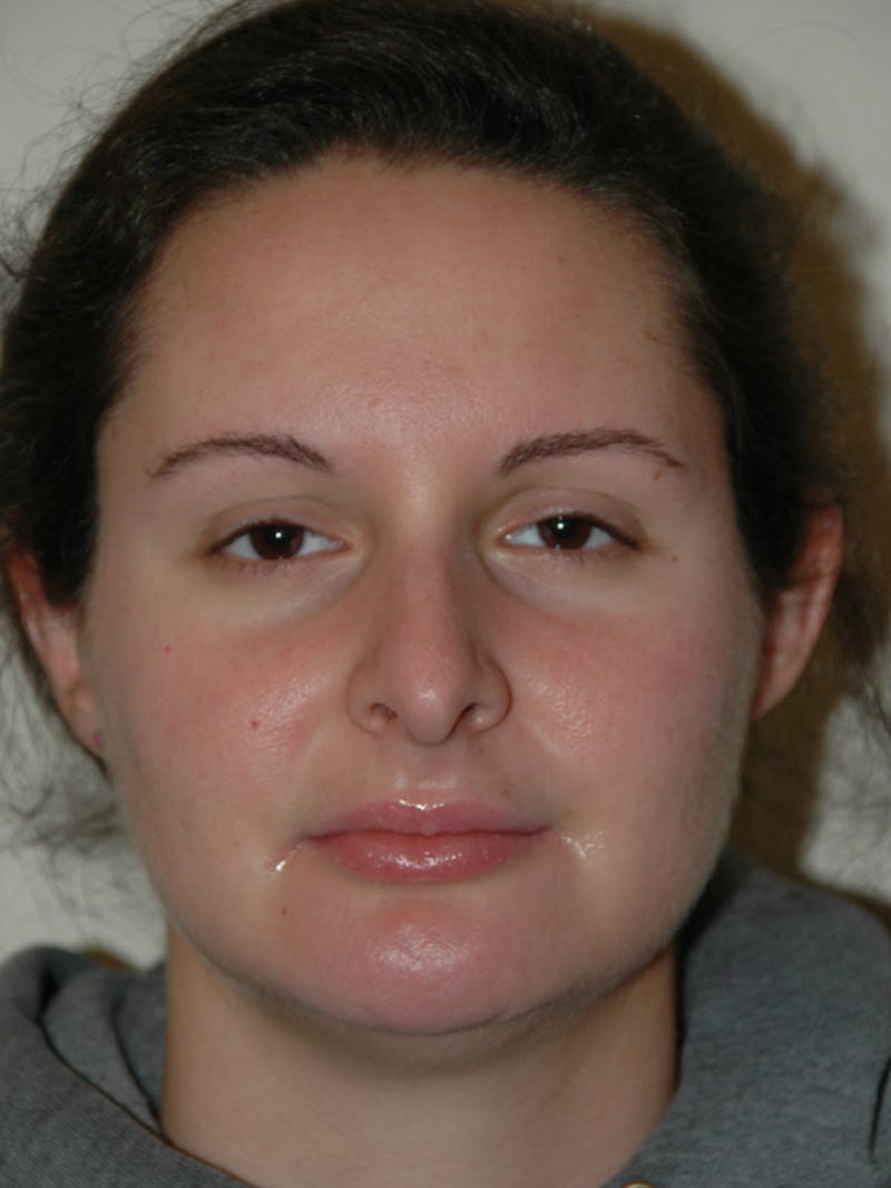 Rhinoplasty Before & After Gallery - Patient 53825281 - Image 3